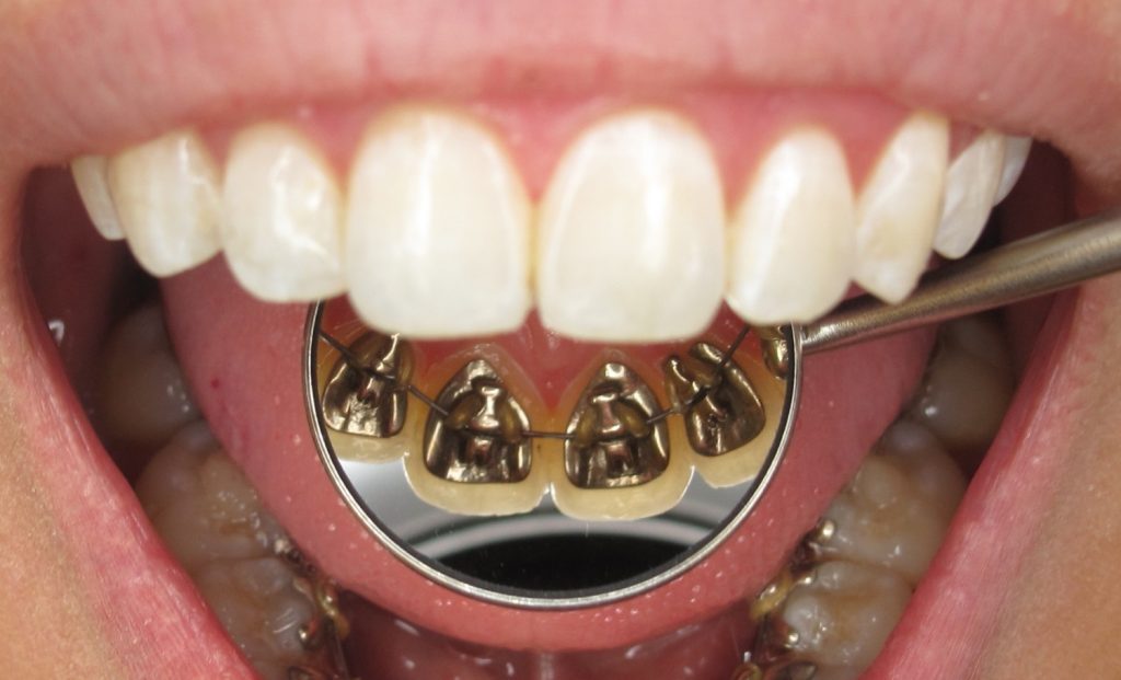 Harmony lingual braces hidden behind teeth